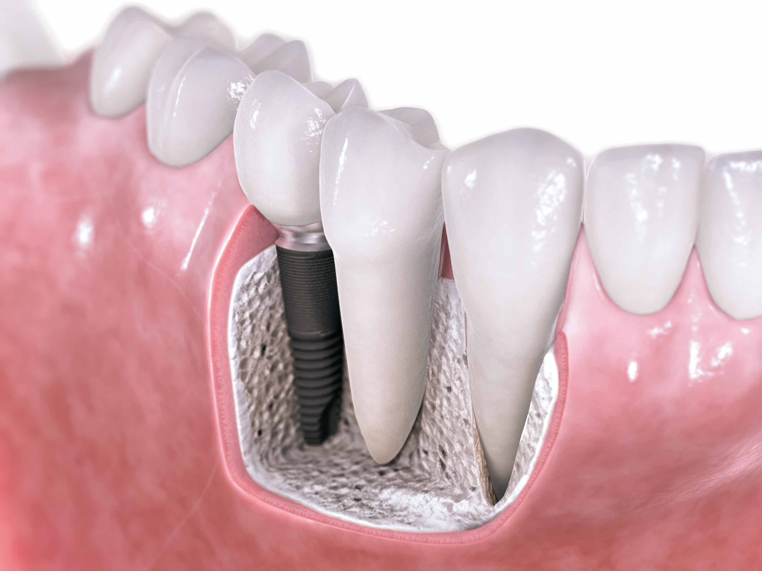 Cắm ghép Implant