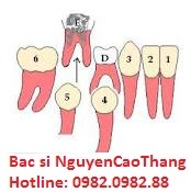 RĂNG SỮA BỊ THAY THẾ NHƯ THẾ NÀO